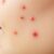 Wysyp pryszczy po laserze frakcyjnym: przyczyny i pielęgnacja